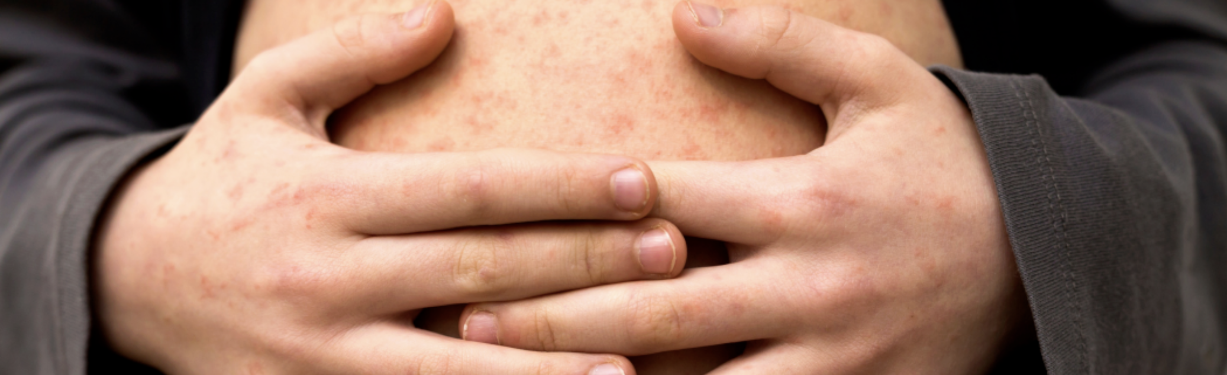 Measles Outbreak – What Colorado Families Need to Know