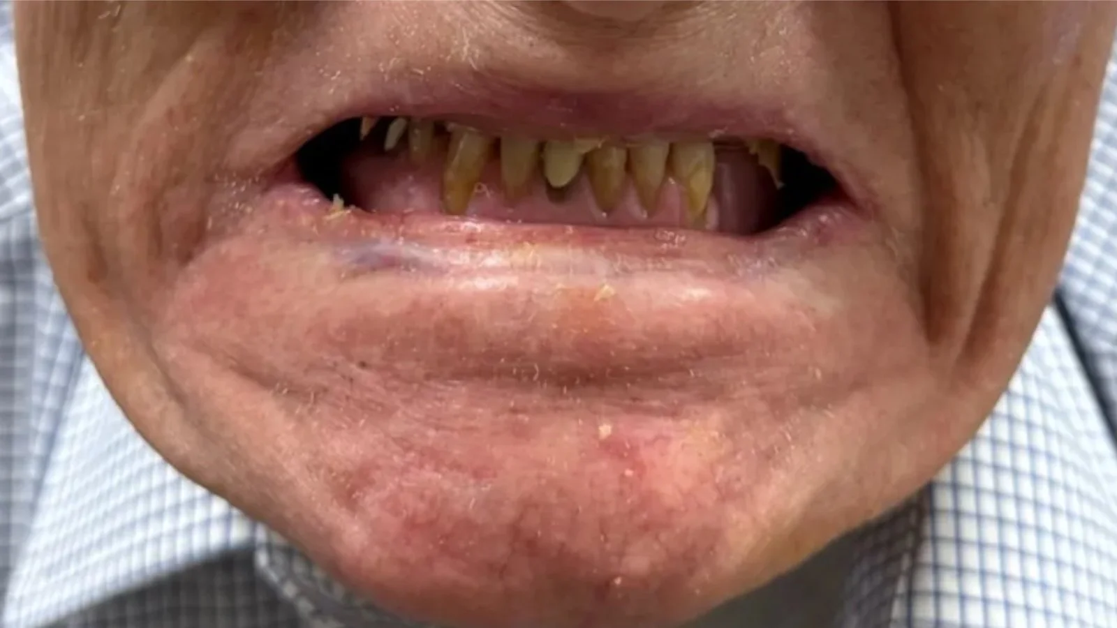 Close-up of an elderly person's mouth with severely decayed and discolored teeth, some with noticeable plaque buildup.