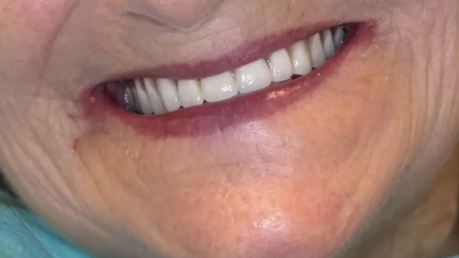 Close-up of a person's smiling mouth showing white teeth and pink lips, with visible skin texture and wrinkles.