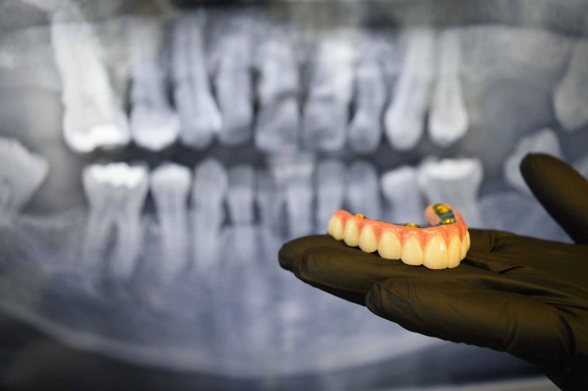 An implant dentist's gloved hand holding a dental implant with a row of artificial teeth in front of a dental X-ray showing a full set of upper and lower teeth.
