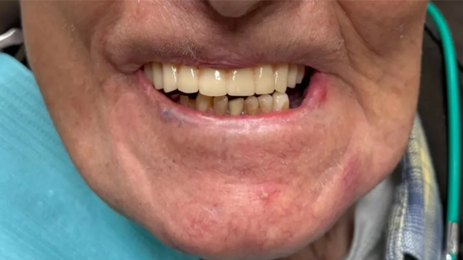 Close-up of a person's smile showing some natural and some tanned or stained teeth, with visible signs of dental wear and neglect.