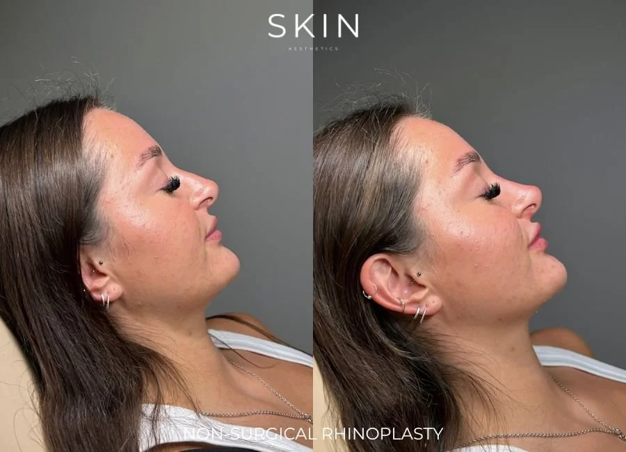 Side-by-side comparison of a woman's face showing before and after non-surgical rhinoplasty, with the label 'Skin Aesthetics' at the top and 'Non-Surgical Rhinoplasty' at the bottom.