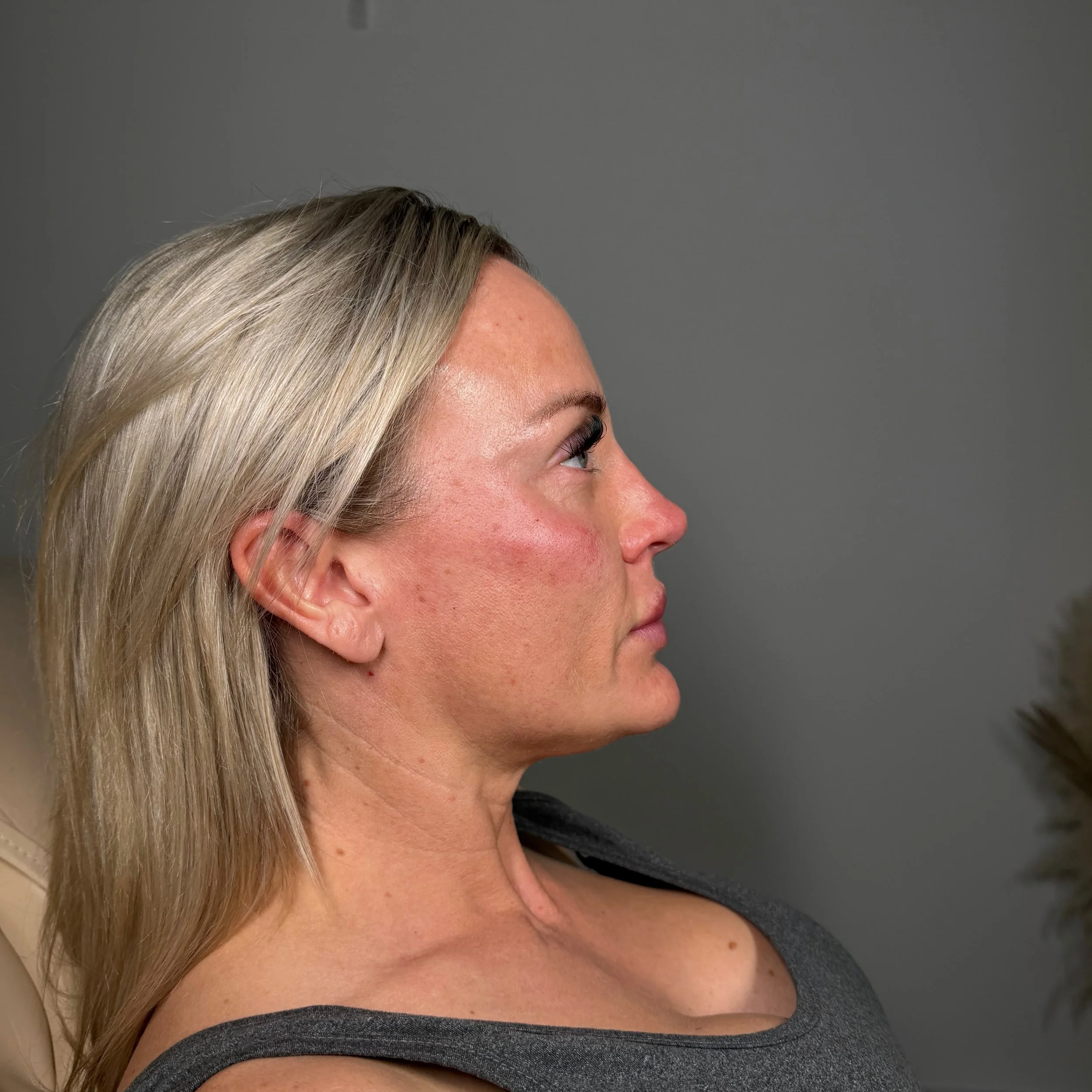 BESPOKE PACKAGE 

SWIPE FOR MORE PHOTOS ⏩️

Small refinements. Beautiful results.

Our signature profile-balancing treatments are designed to enhance harmony, definition and natural beauty, all without surgery.

Non-Surgical Rhinoplasty:

Softens a d