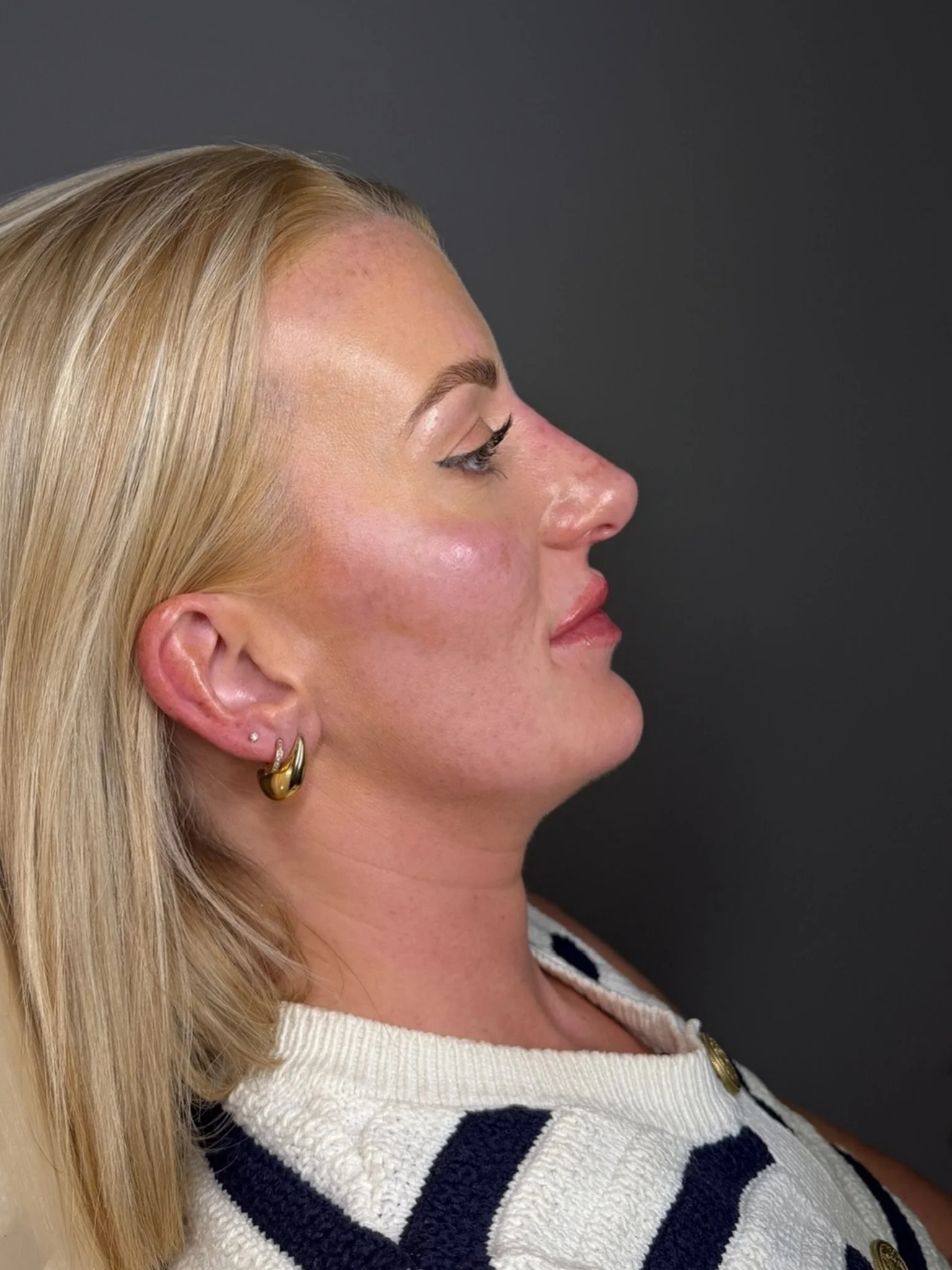 BESPOKE PACKAGE ✨

SWIPE FOR BEFORE PHOTO ⏩️

Full facial balancing, tailored specifically to our client&rsquo;s features and goals.

Cheeks:

Cheek filler helps to restore lost volume, enhance facial structure and create a more lifted appearance. Co
