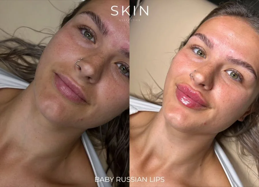 Side-by-side photos of a woman with fair skin and green eyes, showing her before and after lip enhancement. The left image depicts her natural lips, while the right image shows her with glossy, fuller lips. She has a nose ring and is lying down on a bed, wearing a white tank top.
