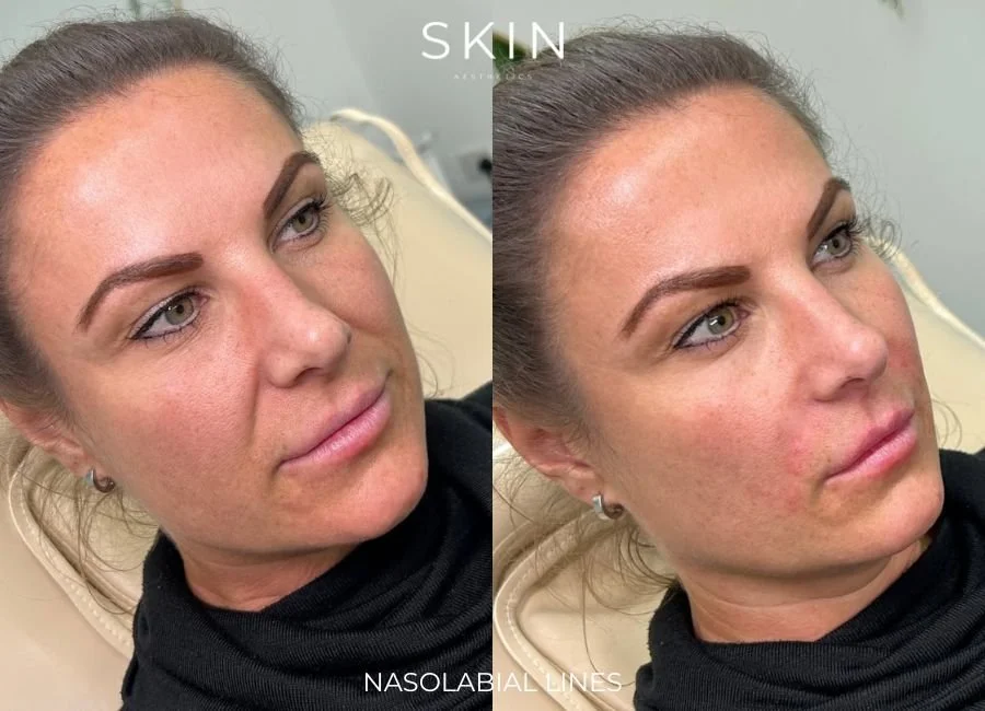 Side-by-side comparison of a woman before and after skincare treatment, showing improved skin texture and reduced visible lines.