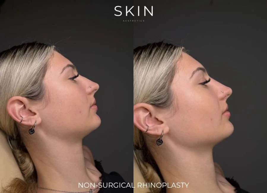Side-by-side comparison of a woman's profile before and after non-surgical rhinoplasty. The results show a more refined nasal shape in the after image.
