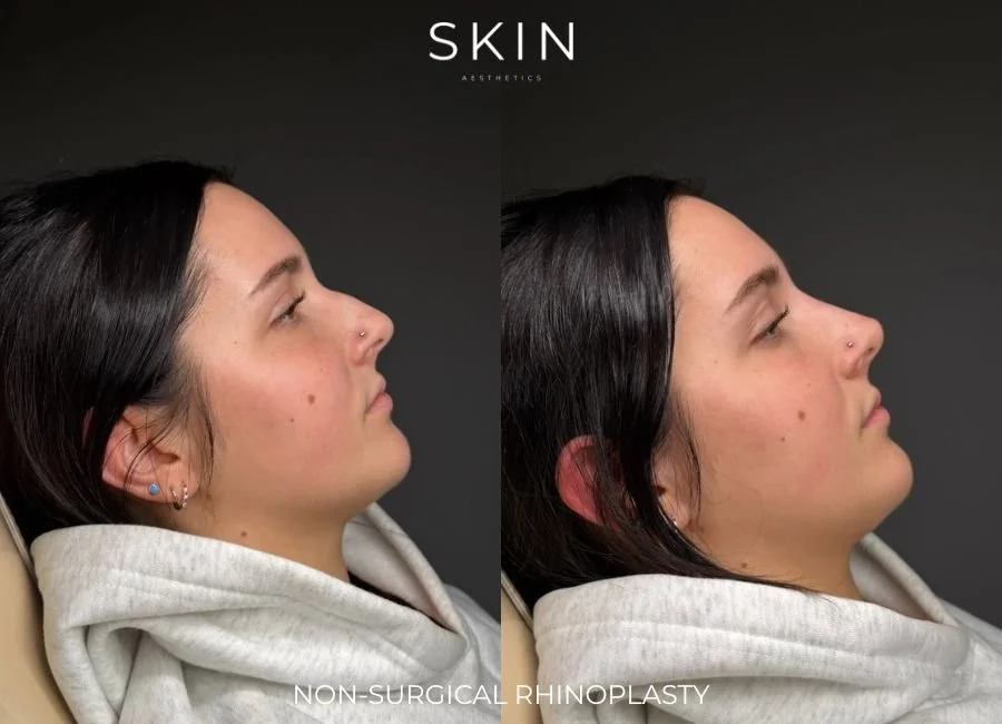 Side-by-side comparison of a woman's face before and after non-surgical rhinoplasty, showing a subtle change in the shape of her nose, with the text 'SKIN Aesthetics' at the top and 'Non-Surgical Rhinoplasty' at the bottom.