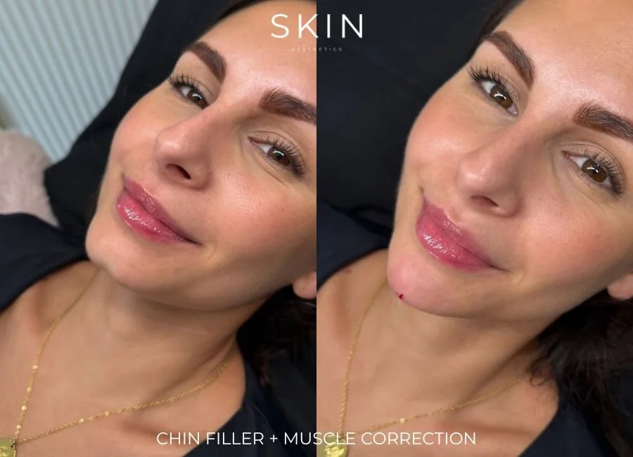 Before and after photos of a woman's face showing chin filler and muscle correction results, with visible improvements in chin shape and facial symmetry.