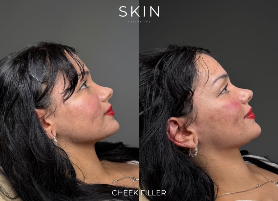 Side-by-side comparison of a woman before and after cheek filler treatment, showing smoother and more contoured cheek area.