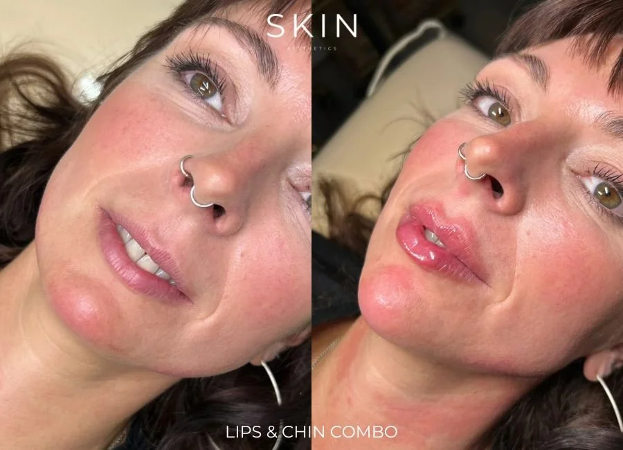 A woman with brown hair and green eyes showcases a before and after of lips and chin enhancement, with the left side showing natural lips and the right side showing glossy, fuller lips.