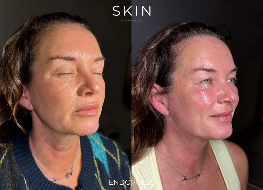 Side-by-side comparison of a woman before and after skin treatment, showing improved skin clarity and texture.