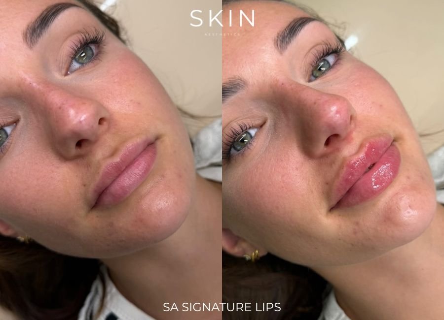 Side-by-side comparison of a woman's face before and after lip enhancement procedure, showcasing fuller, glossy lips.