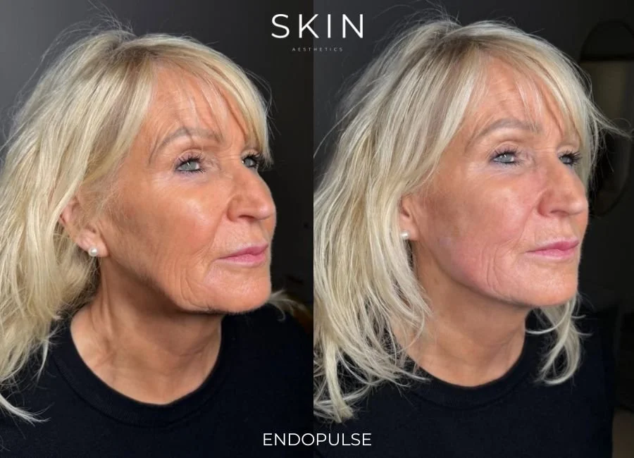 Side-by-side comparison of a woman's face showing before and after skincare treatment results, labeled 'SKIN AESTHETICS' and 'ENDOPULSE'.