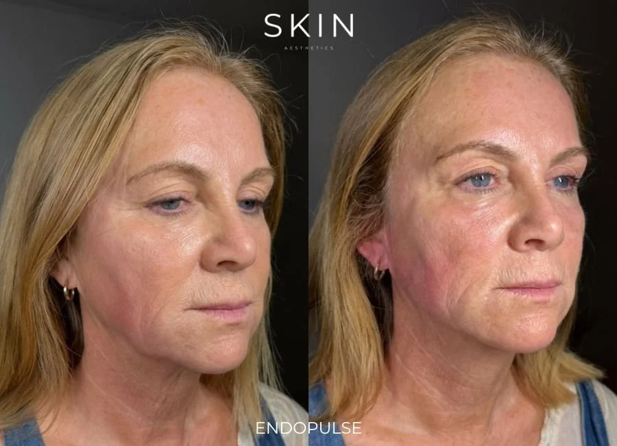 Side-by-side comparison of a woman's face before and after skincare treatment, showing improved skin texture and reduced wrinkles.
