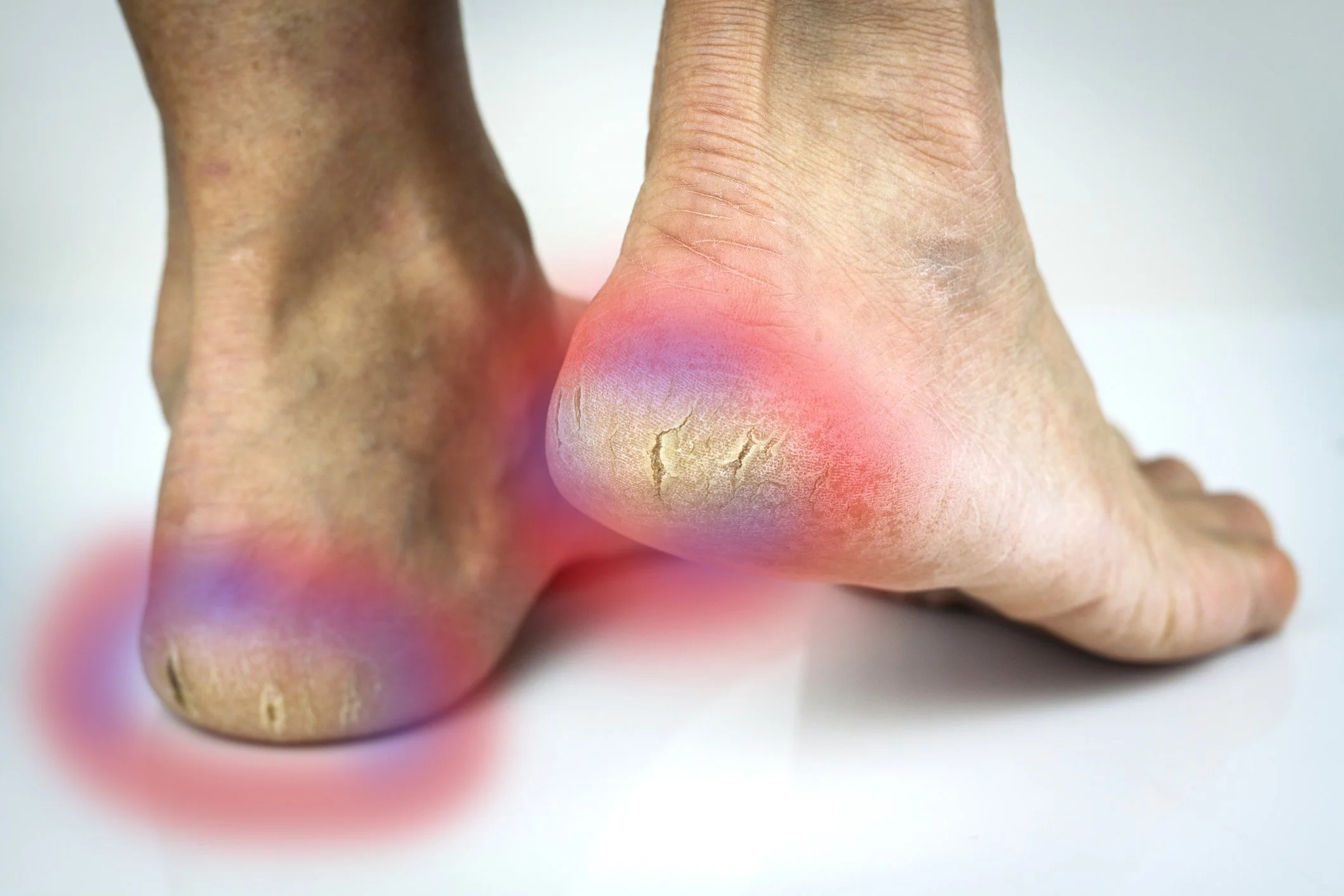 How to fix cracked heels hero image
