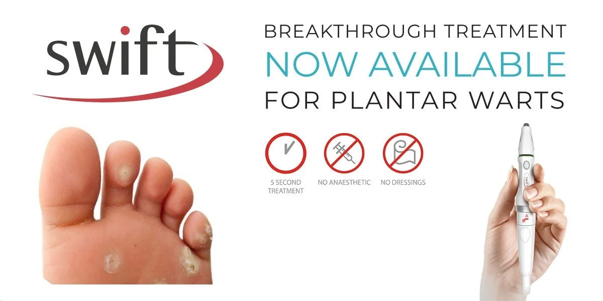 Swift microwave wart treatment by registered chiropodist at Canadian Foot Clinic & Orthotic Centre in St. Catharines — fast, non-invasive wart removal, no down time, expert podiatry and foot care.