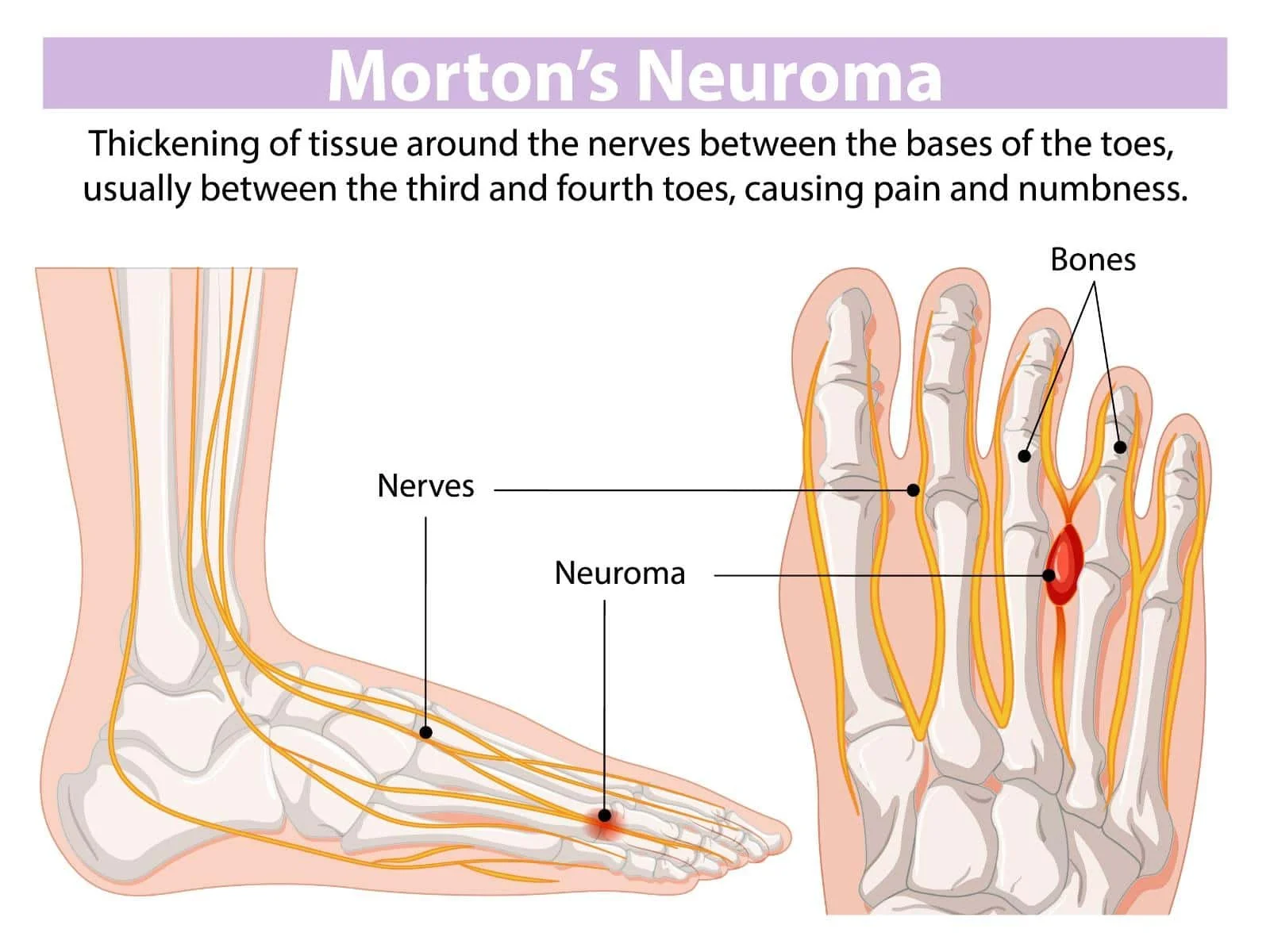 Illustrated Morton's neuroma: painful interdigital nerve, forefoot burning, numbness and pinching; metatarsal pad, custom orthotics, footwear advice and pain relief by registered chiropodist Canadian Foot Clinic & Orthotic Centre, St. Catharines.