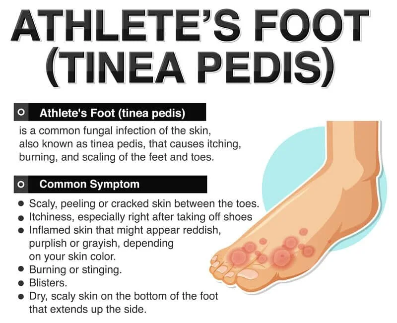 Athlete's foot (tinea pedis) interdigital rash between toes: red, scaly, itchy, burning; antifungal treatment, toe care, footwear advice and prevention by registered chiropodist Canadian Foot Clinic & Orthotic Centre, St. Catharines ON.