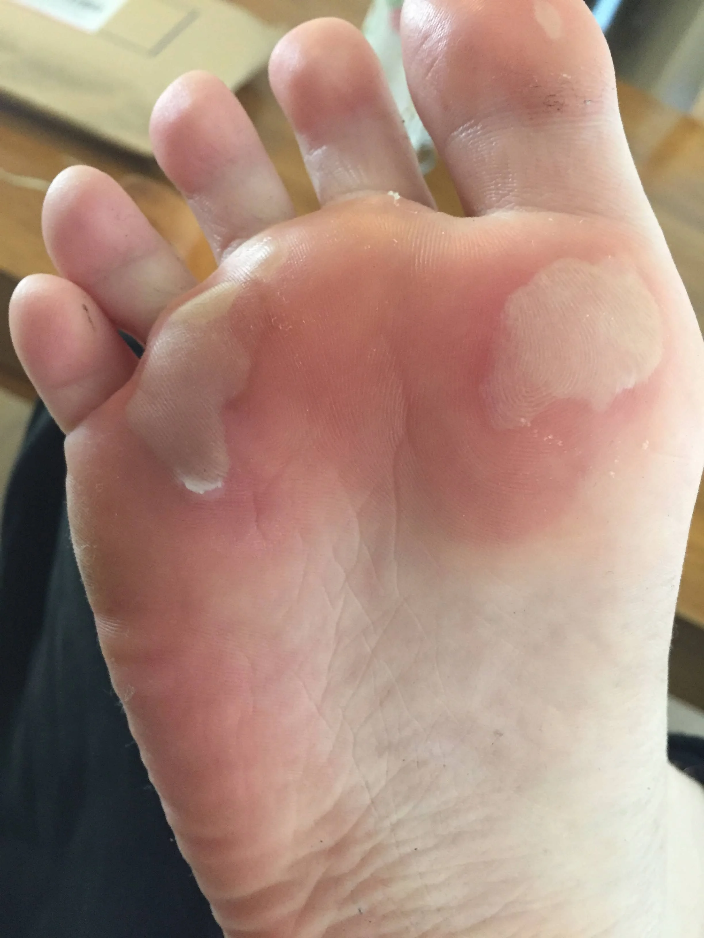 Blisters on ball of foot: painful fluid‑filled lesions under the forefoot causing burning, rubbing and gait disruption; blister care, footwear fixes and custom orthotics by registered chiropodist Canadian Foot Clinic & Orthotic Centre, St. Catharines
