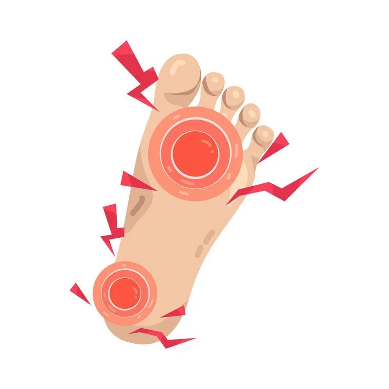 Burning neuropathy foot with red, tingling sole; treatments: foot care, custom orthotics, neuropathic pain management, topical care, footwear advice — registered chiropodist Canadian Foot Clinic & Orthotic Centre, St. Catharines, ON.
