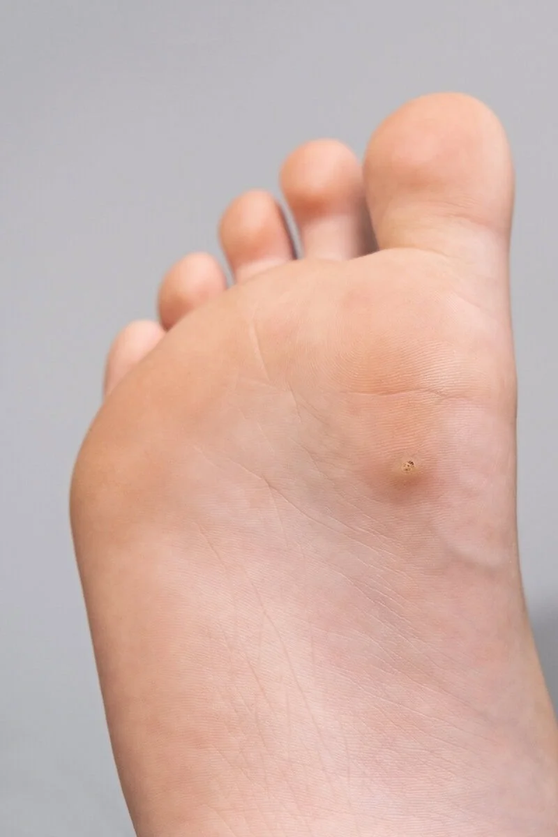 Plantar wart close-up showing treatment options: cryotherapy, microwave ablation, laser therapy and in‑clinic removal — wart care by trusted chiropodist in St. Catharines at Canadian Foot Clinic & Orthotic Centre.