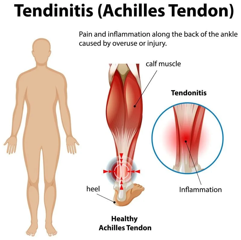 Achilles tendonitis pain and inflammation illustration registered chiropodist canadian foot clinic and orthotic centre st. catharines ON