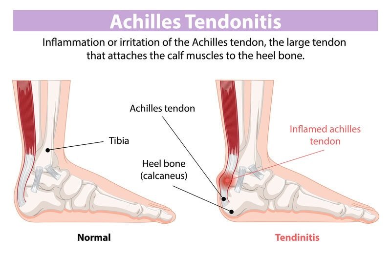 Illustrated Achilles tendonitis: inflamed Achilles tendon, heel pain and swelling; Achilles pain relief, tendon care, heel treatment and custom orthotics by registered chiropodist Canadian Foot Clinic & Orthotic Centre, St. Catharines.