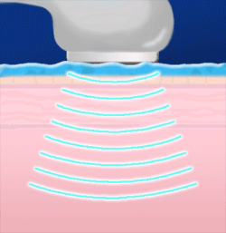 Ultrasound illustration showing therapeutic effect and increased healing speed.  Registered Chiropodist at Canadian Foot Clinic & Orthotic Centre in St. Catharines