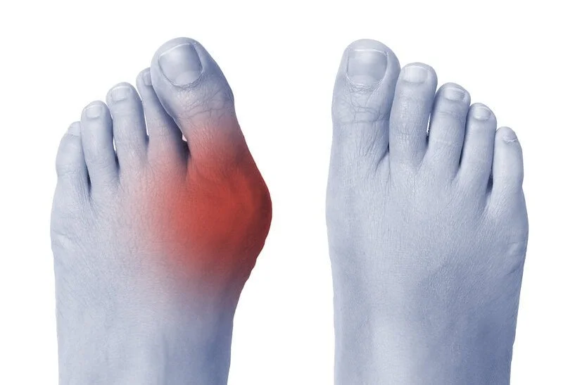 Painful bunion deformity with swollen, misaligned big toe and redness — bunion pain, hallux valgus diagnosis, custom orthotics, conservative care and surgical options at Canadian Foot Clinic & Orthotic Centre, St. Catharines.