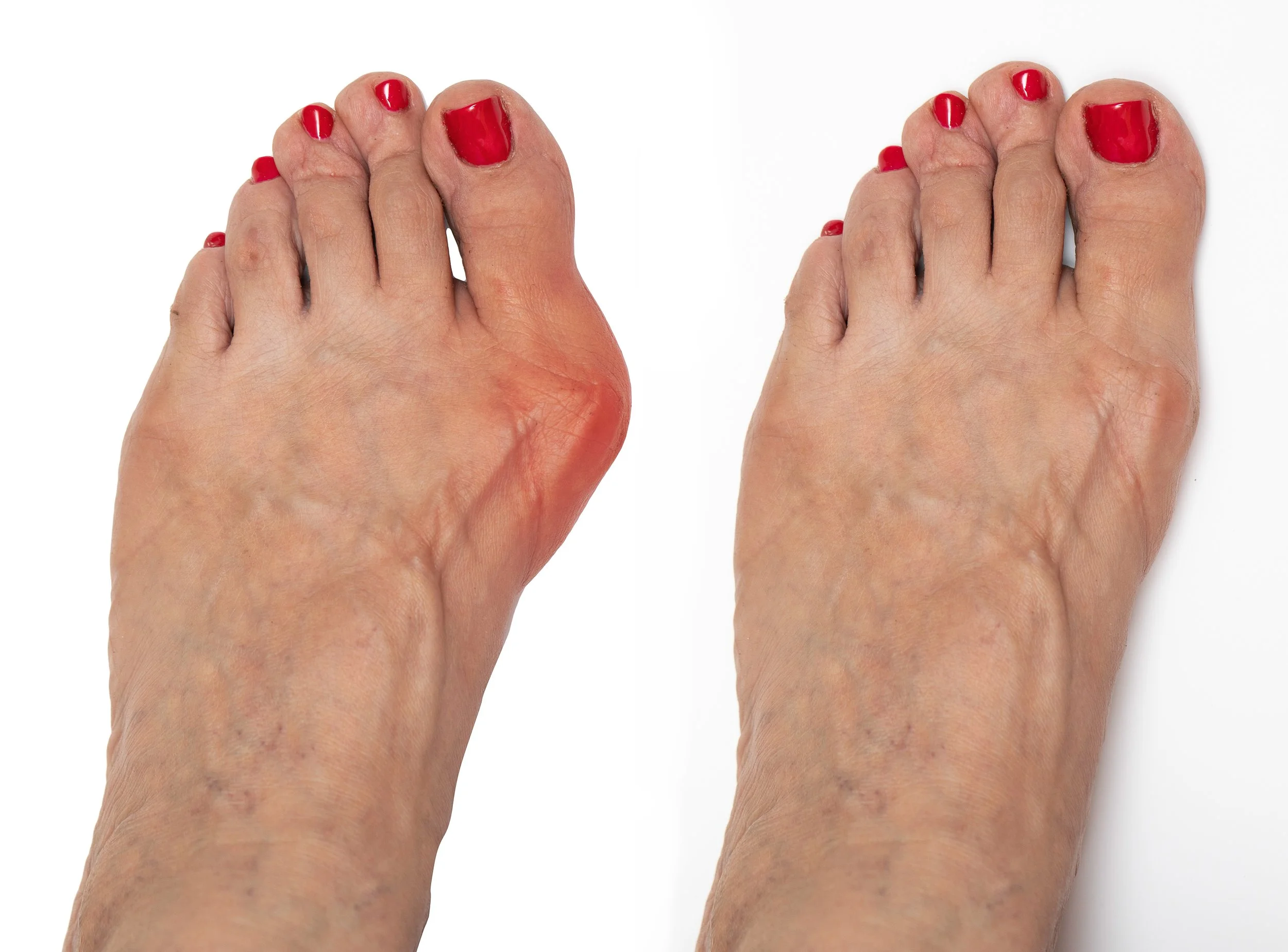 Painful bunion deformity before and after correction showing swollen, misaligned big toe and post‑correction straightening; hallux valgus relief, bunion surgery and custom orthotics by Canadian Foot Clinic & Orthotic Centre, St. Catharines.