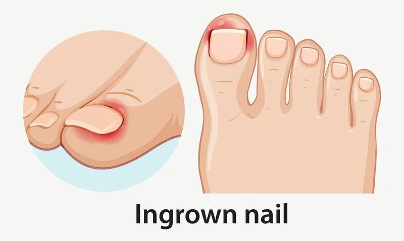 Painful Ingrown toenail infection showing redness and swelling; ingrown toenail correction by registered chiropodist at Canadian Foot Clinic & Orthotic Centre in St. Catharines, Ontario.