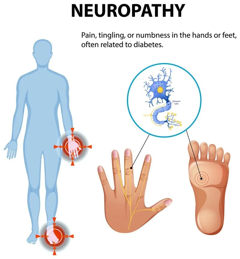 Burning, tingling neuropathy illustration of hands and feet nerve pain, numbness and signal loss; foot care, neuropathic pain management and custom orthotics — registered chiropodist at Canadian Foot Clinic & Orthotic Centre, St. Catharines.