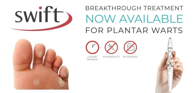 Swift microwave wart treatment by registered chiropodist at Canadian Foot Clinic & Orthotic Centre in St. Catharines — fast, noninvasive wart removal, no down time, expert podiatry and foot care.