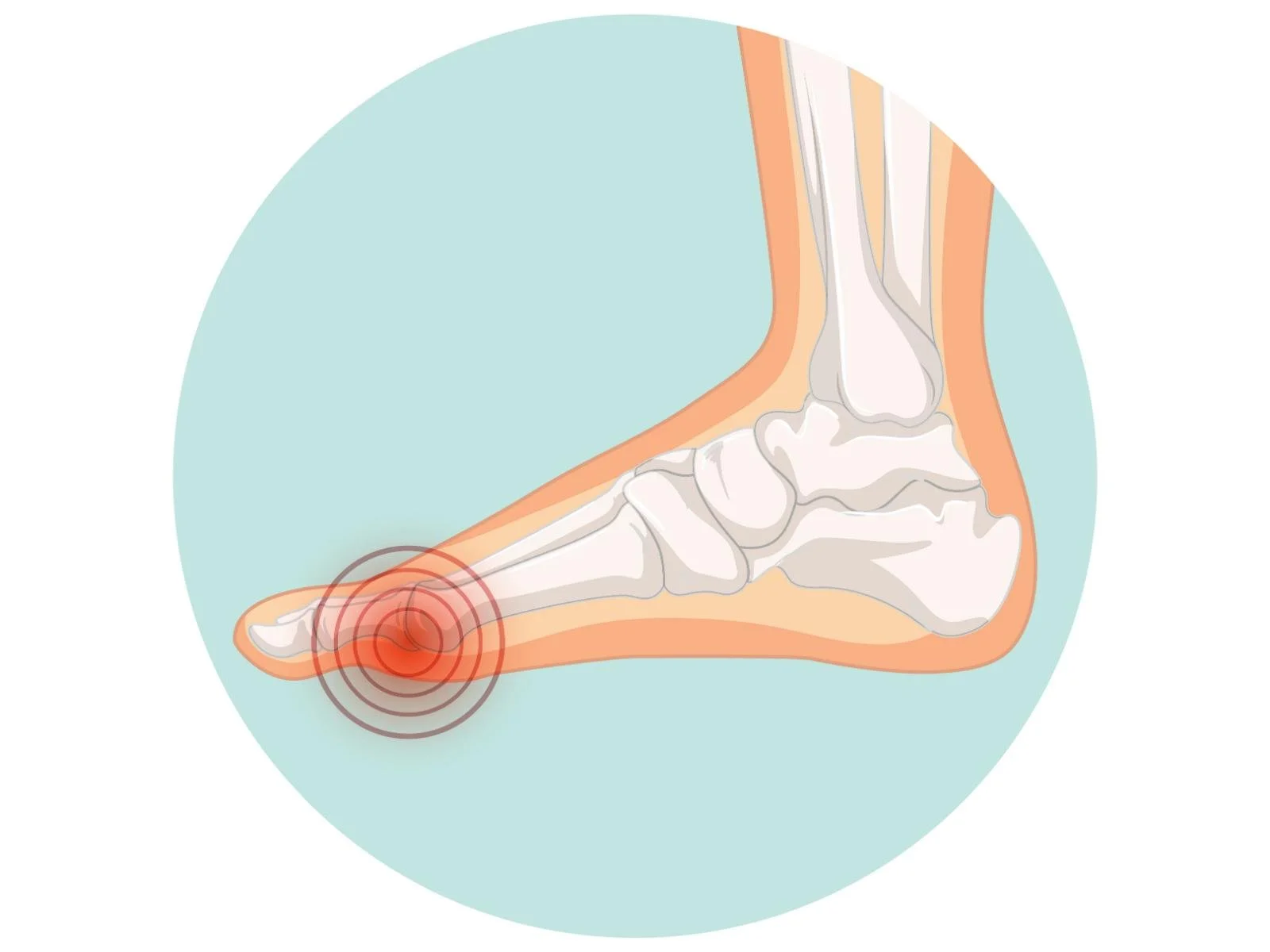 Sesamoiditis under the big toe: tender, sharp forefoot pain and swelling; metatarsal offloading, padding, custom orthotics by registered chiropodist Canadian Foot Clinic & Orthotic Centre, St. Catharines ON.