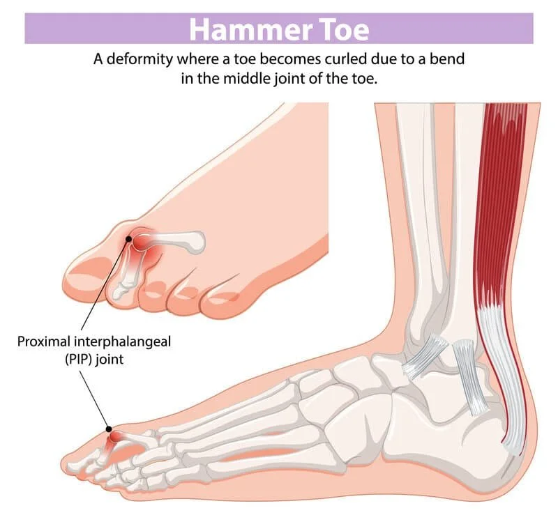 Hammertoe deformity showing a painful bent middle toe joint, corns and pressure points; hammertoe diagnosis, splints, conservative care, custom orthotics at Canadian Foot Clinic & Orthotic Centre, St. Catharines.