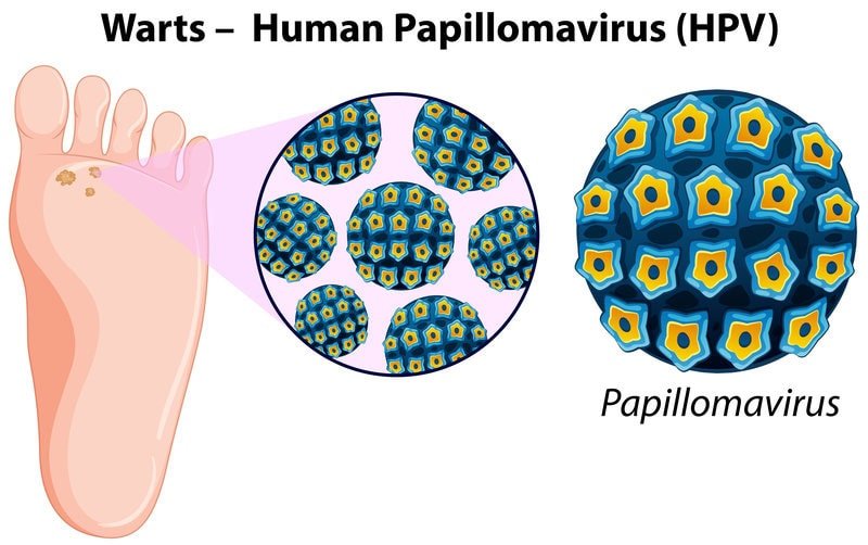 Foot warts HPV virus verruca; fast, effective wart treatments offered — cryotherapy, microwave, laser and in‑clinic removal by trusted chiropodist in St. Catharines at Canadian Foot Clinic & Orthotic Centre