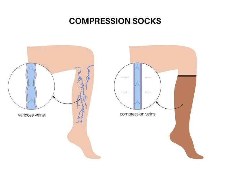 Compression stockings for varicose veins — custom measured fittings, graduated compression, edema and venous support; diabetic‑friendly hosiery by registered chiropodist in St. Catharines, Canadian Foot Clinic & Orthotic Centre.