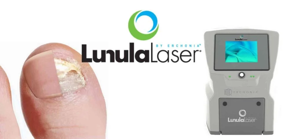 Lunula Laser device with fungal toenail close-up; registered chiropodist treatment at Canadian Foot Clinic & Orthotic Centre, St. Catharines — laser toenail fungus treatment, onychomycosis care.