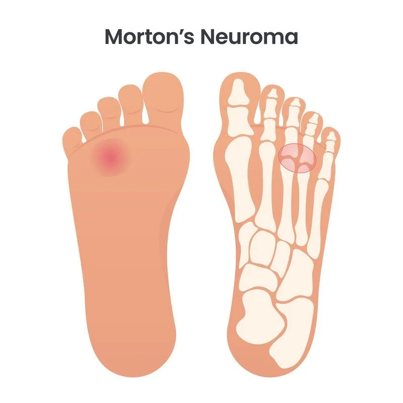 Morton's neuroma pain with throbbing registered chiropodist at canadian foot clinic and orthotic centre St. Catharines ON