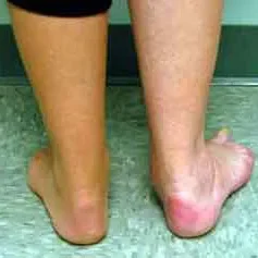 PTTD adult acquired flatfoot rear view: normal vs collapsed arch with heel valgus; posterior tibial tendon dysfunction, gait issues; flatfoot care and custom orthotics by registered chiropodist Canadian Foot Clinic & Orthotic Centre, St. Catharines.