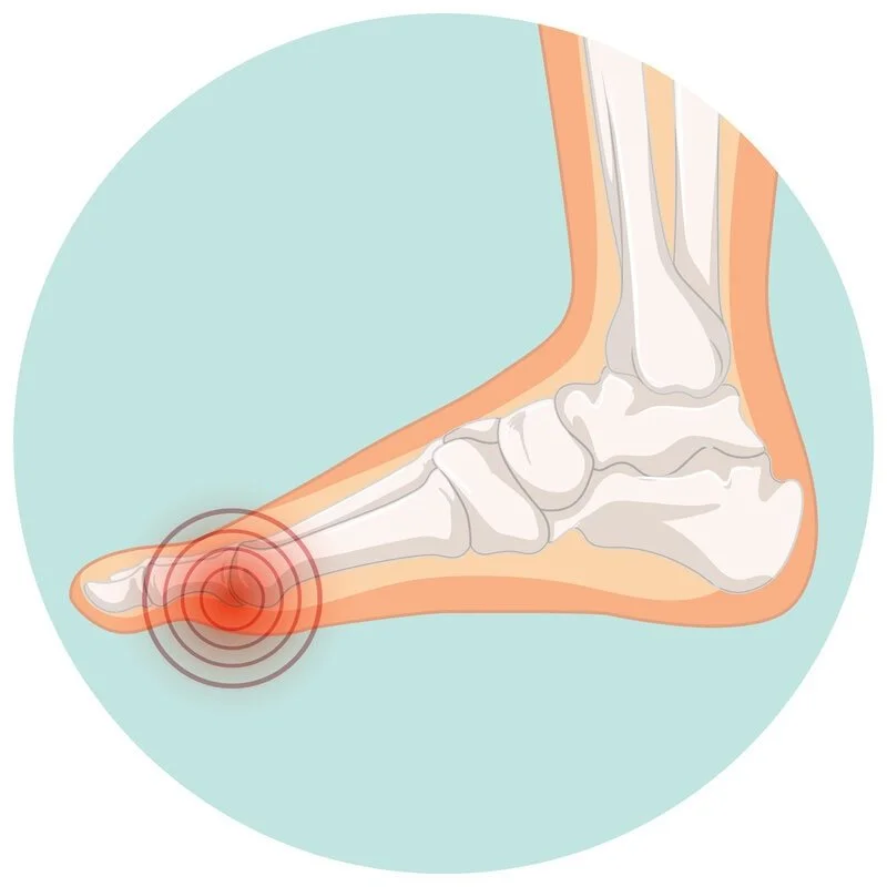 Hallux limitus (big toe arthritis): stiff, painful big toe joint limiting push‑off; joint care, footwear advice and custom orthotics by registered chiropodist Canadian Foot Clinic & Orthotic Centre, St. Catharines ON.