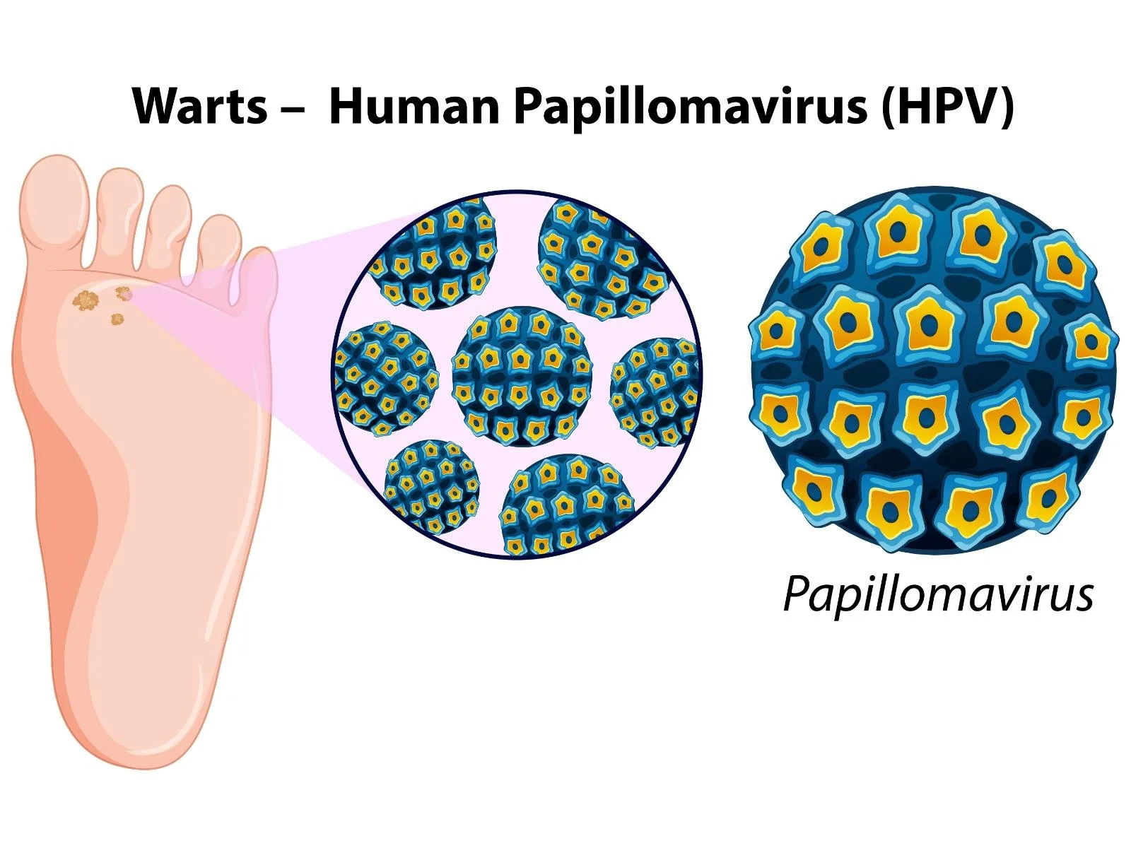 Foot warts HPV virus verruca; fast, effective wart treatments offered — cryotherapy, microwave, laser and in‑clinic removal by registered chiropodist in St. Catharines at Canadian Foot Clinic & Orthotic Centre