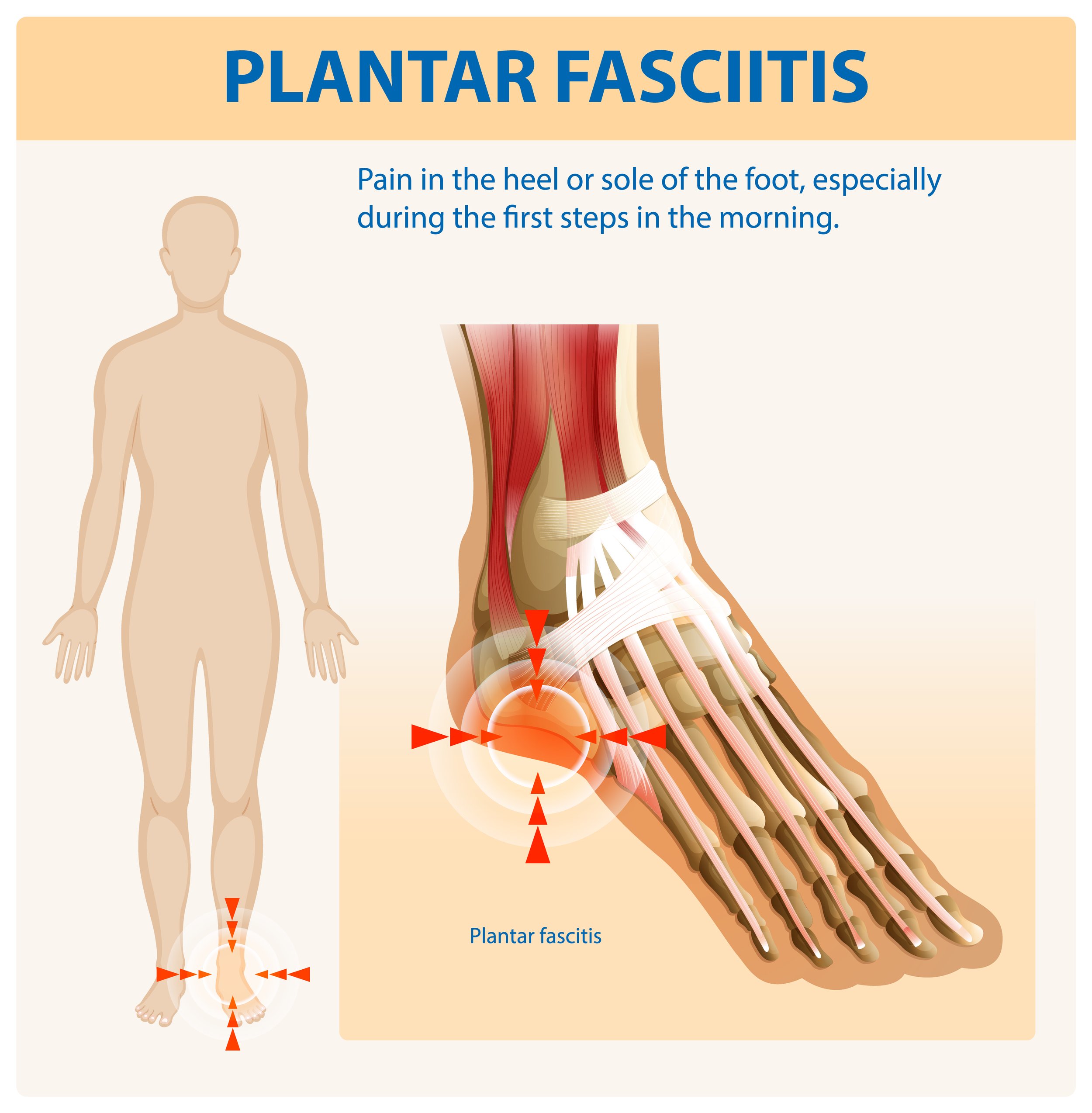 Plantar fasciitis heel pain heel spur illustration and treatment by registered chiropodist at Canadian Foot Clinic & Orthotic Centre, St. Catharines, ON