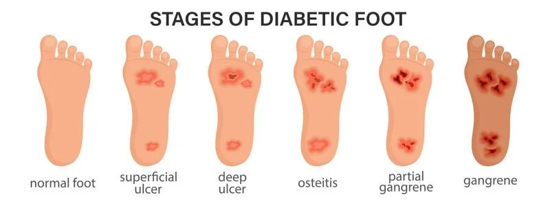 Stages of diabetic foot wound showing ulcer progression and tissue breakdown — diabetic foot care, wound assessment, debridement, offloading, infection management; registered chiropodist Canadian Foot Clinic & Orthotic Centre, St. Catharines.