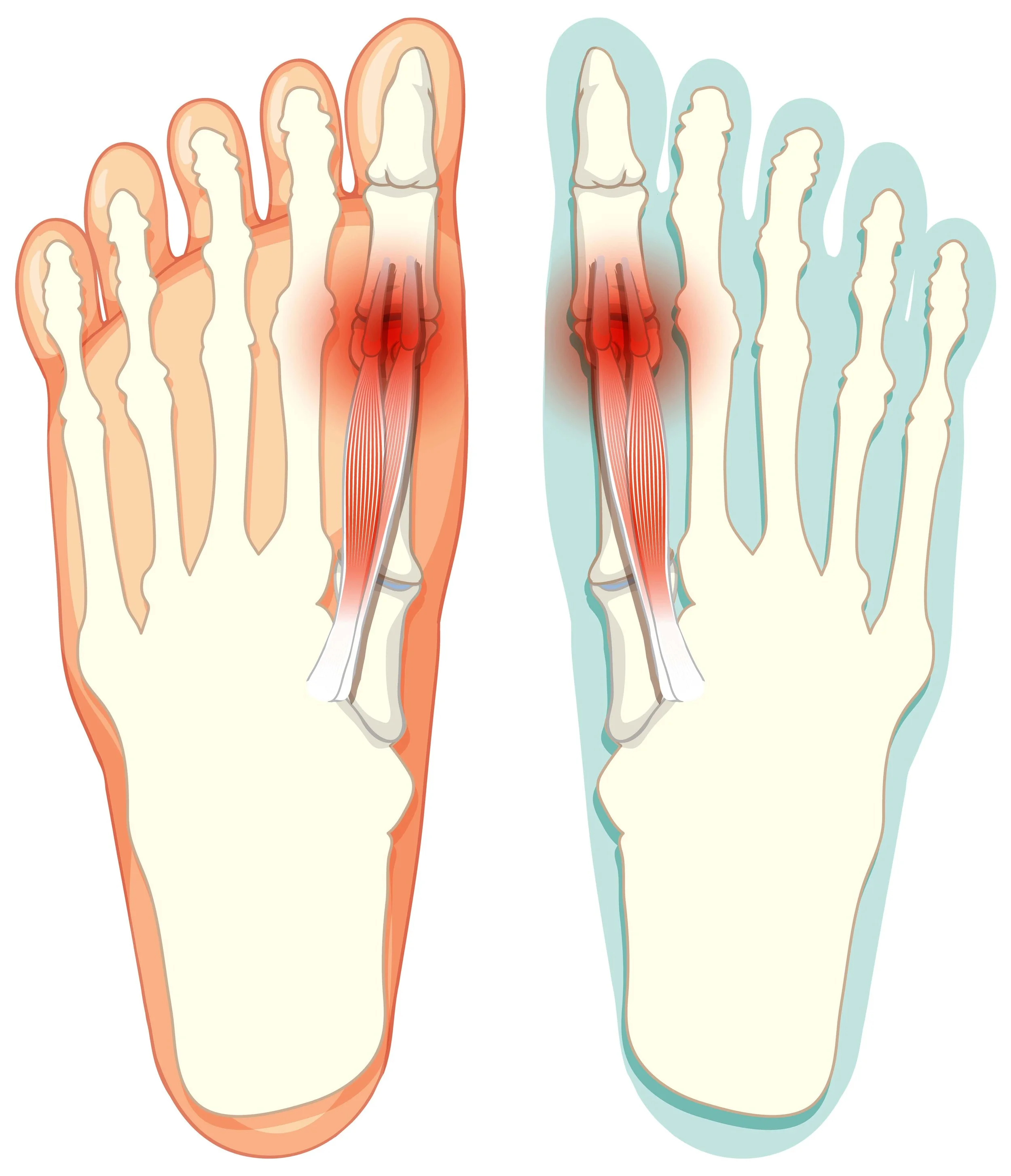 Sesamoiditis under big toe: sharp forefoot pain, swelling and tenderness; metatarsal offloading, padding, custom orthotics and expert care by registered chiropodist Canadian Foot Clinic & Orthotic Centre, St. Catharines ON.
