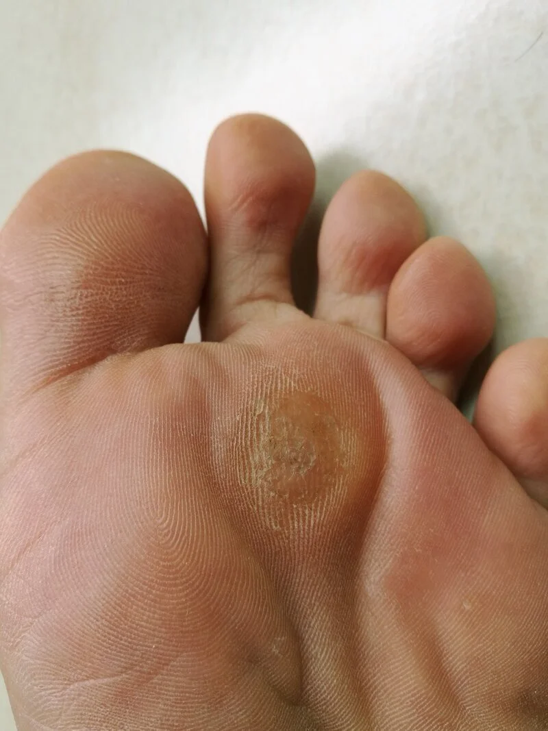 Comprehensive foot care by registered chiropodist in St. Catharines — toenail debridement, corn & callus care, medical pedicure, and custom orthotics treatment at Canadian Foot Clinic & Orthotic Centre.