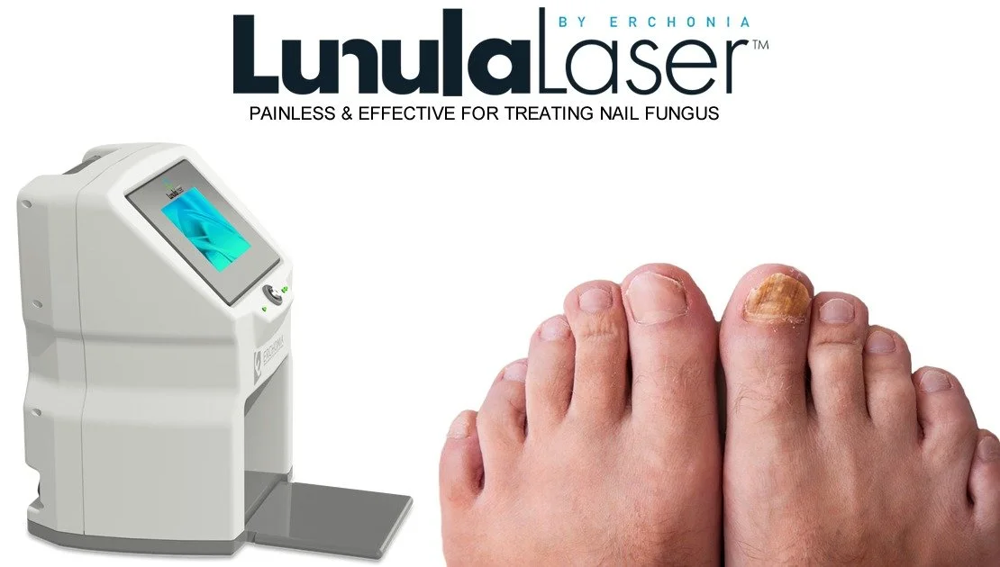 Lunula Laser device with fungal toenail close-up; registered chiropodist treatment at Canadian Foot Clinic & Orthotic Centre, St. Catharines — laser toenail fungus treatment, onychomycosis care.