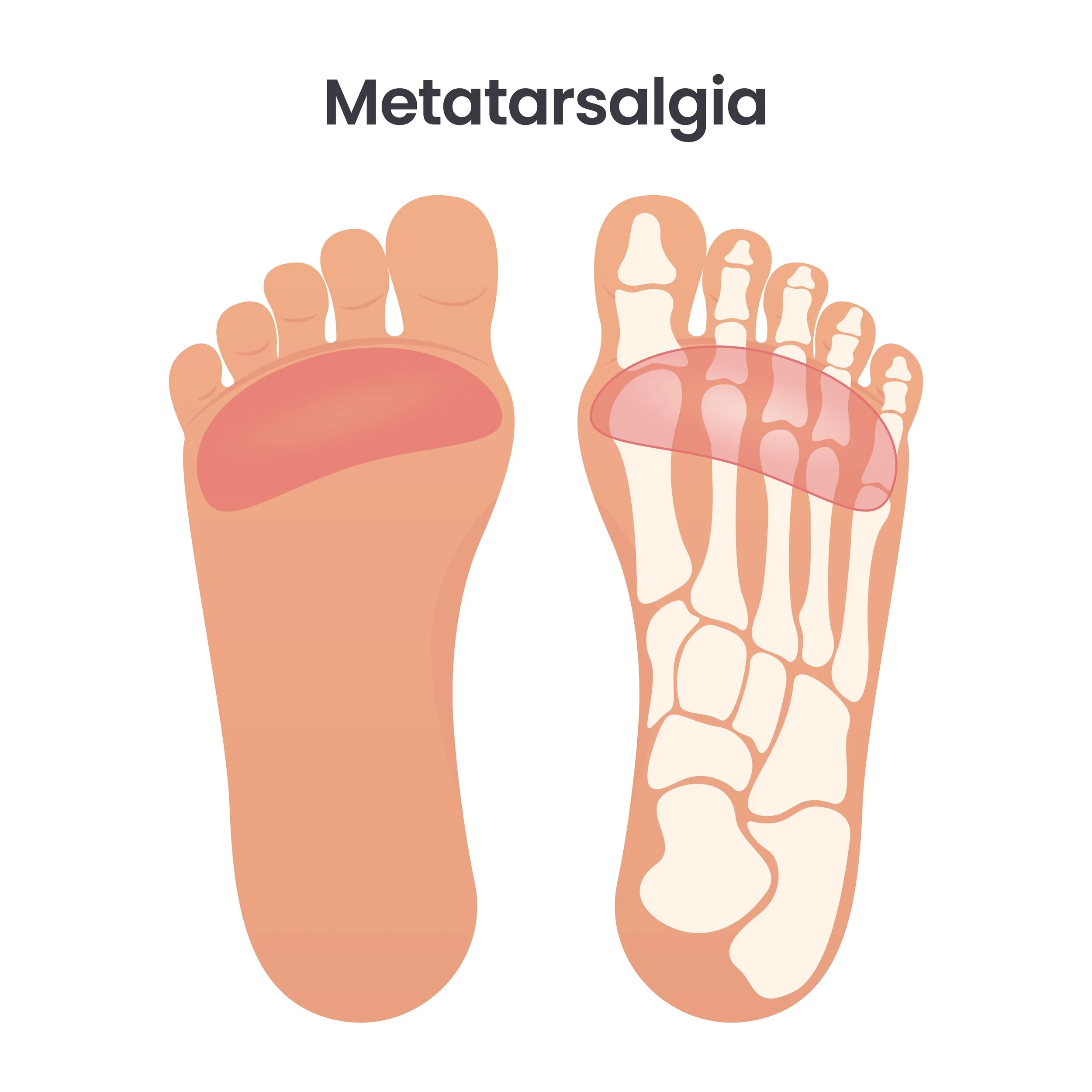 Illustrated metatarsalgia: throbbing ball of foot, inflamed metatarsal heads and nerve irritation; forefoot pain, neuroma; custom orthotics at Canadian Foot Clinic & Orthotic Centre, St. Catharines.