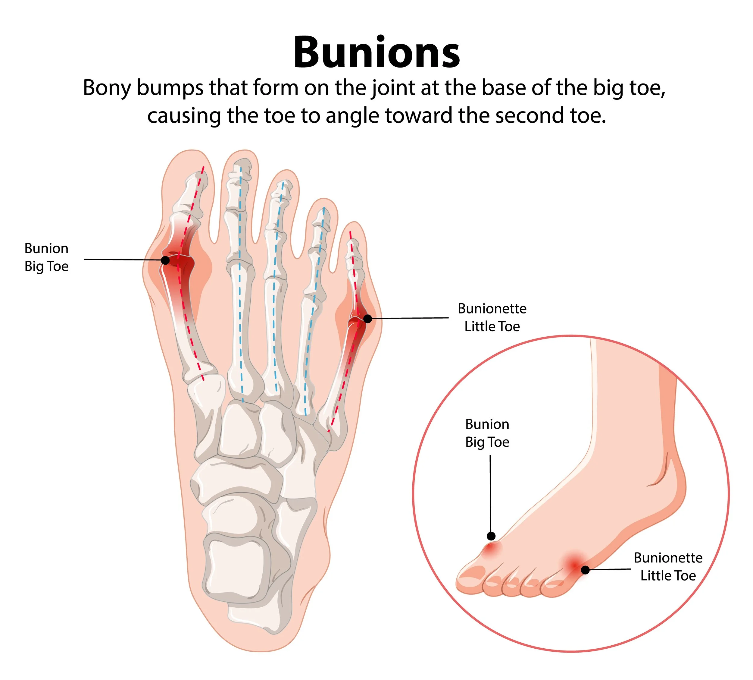 Painful bunion illustration of swollen, misaligned big toe and bump — hallux valgus, bunion pain, diagnosis, custom orthotics, conservative or surgical options at Canadian Foot Clinic & Orthotic Centre, St. Catharines.